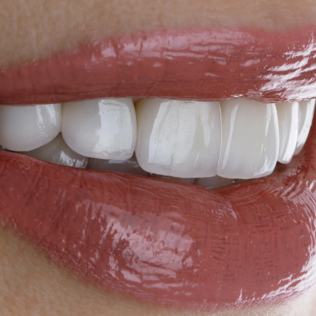 Primer plano de sonrisa perfecta con carillas de composite